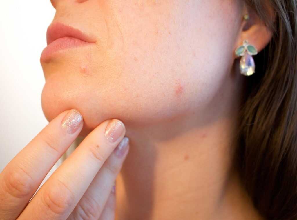 combat acne dermatologists